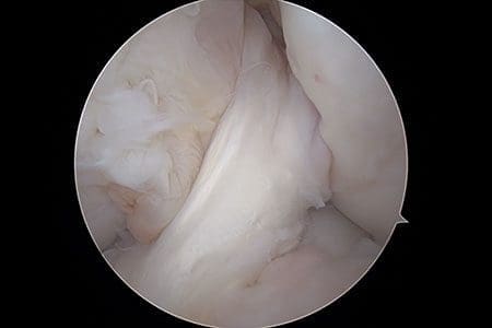 Ligament stabilization procedures