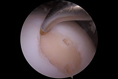 Microfracture