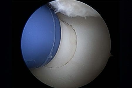 Osteochondral autograft transplantation