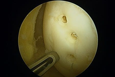 Osteochondritis repair and fixation